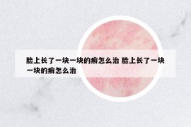 臉上長了一塊一塊的癬怎么治 臉上長了一塊一塊的癬怎么治