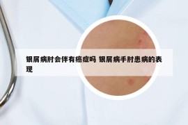 銀屑病肘會(huì)伴有癌癥嗎 銀屑病手肘患病的表現(xiàn)