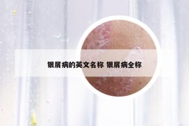 銀屑病的英文名稱 銀屑病全稱