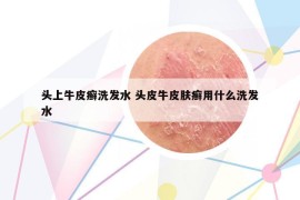 頭上牛皮癬洗發(fā)水 頭皮牛皮膚癬用什么洗發(fā)水