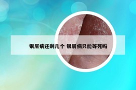 銀屑病還剩幾個(gè) 銀屑病只能等死嗎