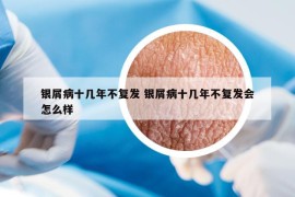 銀屑病十幾年不復(fù)發(fā) 銀屑病十幾年不復(fù)發(fā)會怎么樣