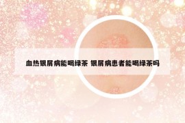 血熱銀屑病能喝綠茶 銀屑病患者能喝綠茶嗎