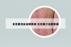 無花果泡水治銀屑病 無花果汁治銀屑病