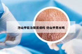 泡山甲能治銀屑病嗎 炮山甲煮水喝