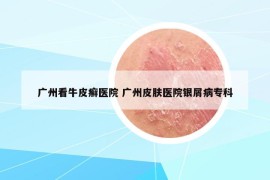 廣州看牛皮癬醫(yī)院 廣州皮膚醫(yī)院銀屑病?？? /></a>		
		</figure>

		<header class=