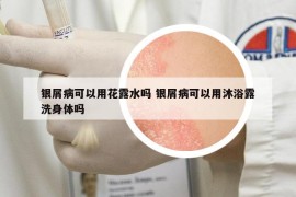 銀屑病可以用花露水嗎 銀屑病可以用沐浴露洗身體嗎