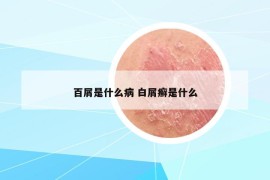 百屑是什么病 白屑癬是什么