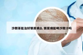 沙棘茶能治好銀屑病么 銀屑病能喝沙棘汁嗎