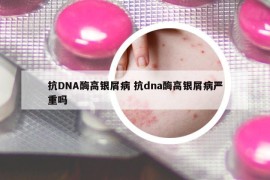 抗DNA酶高銀屑病 抗dna酶高銀屑病嚴(yán)重嗎