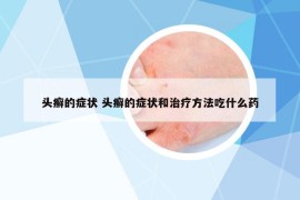 頭癬的癥狀 頭癬的癥狀和治療方法吃什么藥