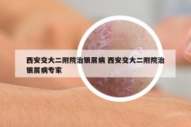 西安交大二附院治銀屑病 西安交大二附院治銀屑病專家