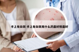 手上有白斑 手上有白斑用什么藥最好擦最好
