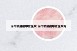 治療銀屑病哪些醫(yī)院 治療銀屑病哪些醫(yī)院好