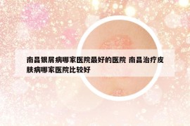 南昌銀屑病哪家醫(yī)院最好的醫(yī)院 南昌治療皮膚病哪家醫(yī)院比較好
