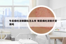 牛皮癬吃消銀顆粒怎么樣 銀屑病吃消銀片管用嗎