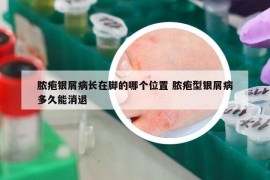 膿皰銀屑病長(zhǎng)在腳的哪個(gè)位置 膿皰型銀屑病多久能消退
