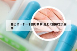 腿上長一個(gè)一個(gè)圓形的癬 腿上長圓癬怎么回事