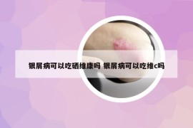 銀屑病可以吃硒維康嗎 銀屑病可以吃維c嗎