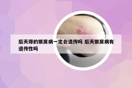 后天得的銀屑病一定會遺傳嗎 后天銀屑病有遺傳性嗎
