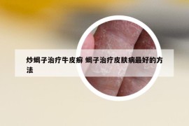 炒蝎子治療牛皮癬 蝎子治療皮膚病最好的方法