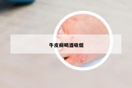 牛皮癬喝酒吸煙