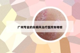 廣州專業(yè)的白癜風(fēng)治療醫(yī)院有哪些