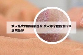 武漢最大的銀屑病醫(yī)院 武漢哪個醫(yī)院治療銀屑病最好