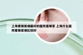 上?？淬y屑病最好的醫(yī)院是哪家 上海什么醫(yī)院看銀屑病比較好