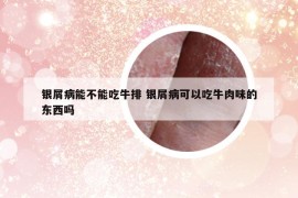 銀屑病能不能吃牛排 銀屑病可以吃牛肉味的東西嗎