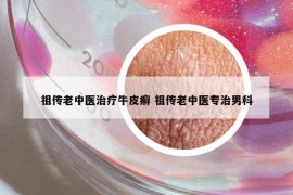 祖?zhèn)骼现嗅t(yī)治療牛皮癬 祖?zhèn)骼现嗅t(yī)專治男科