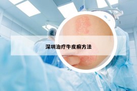 深圳治療牛皮癬方法
