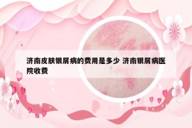 濟(jì)南皮膚銀屑病的費(fèi)用是多少 濟(jì)南銀屑病醫(yī)院收費(fèi)