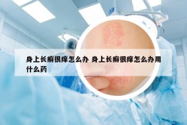 身上長癬很癢怎么辦 身上長癬很癢怎么辦用什么藥