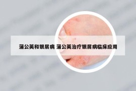 蒲公英和銀屑病 蒲公英治療銀屑病臨床應(yīng)用