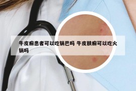 牛皮癬患者可以吃鍋巴嗎 牛皮膚癬可以吃火鍋嗎