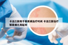 卡泊三醇用于銀屑病治療時(shí)間 卡泊三醇治療銀屑病幾周起效