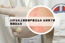 20歲女頭上銀屑病嚴重怎么辦 女孩得了銀屑病怎么辦