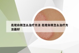 出現(xiàn)白斑怎么治療方法 出現(xiàn)白斑怎么治療方法最好