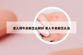 老人得牛皮癬怎么制好 老人牛皮癬怎么治