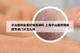 華山醫(yī)院能看好銀屑病嗎 上海華山醫(yī)院銀屑病專病門診怎么樣