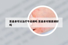 蒸桑拿可以治療牛皮癬嗎 蒸桑拿對銀屑病好嗎