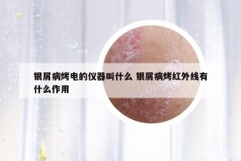 銀屑病烤電的儀器叫什么 銀屑病烤紅外線有什么作用