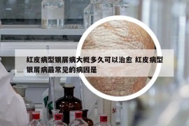 紅皮病型銀屑病大概多久可以治愈 紅皮病型銀屑病最常見(jiàn)的病因是