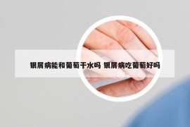銀屑病能和葡萄干水嗎 銀屑病吃葡萄好嗎