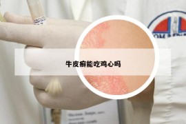 牛皮癬能吃雞心嗎