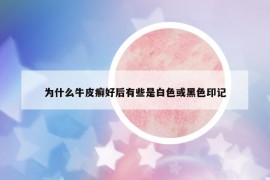 為什么牛皮癬好后有些是白色或黑色印記