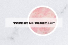 掌跖膿包病怎么治 掌跖膿皰怎么治療