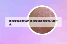 斑塊型銀屑病貼吧 斑塊型銀屑病常用藥是什么