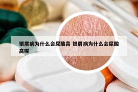 銀屑病為什么會(huì)尿酸高 銀屑病為什么會(huì)尿酸高呢